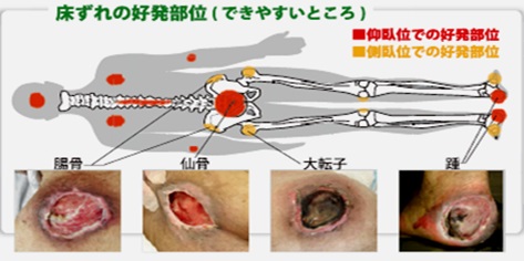 床ずれのできやすいところ