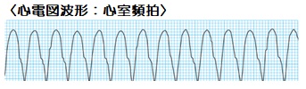 心室頻拍波形