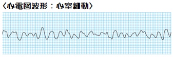 心室細動波形