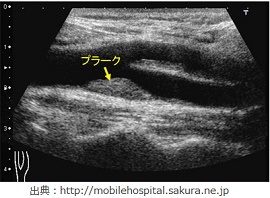 頸動脈エコー検査_画像2